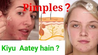 Pimples Kiyu Aate Hai  Pimples Kaise Aate Hai  Hair Follicles Block Kaise Hote Hai [upl. by Notyap]