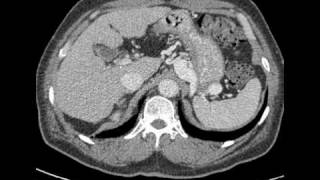 CT interpretation  portorenal shunt in cirrhotic patient [upl. by Sillaw974]