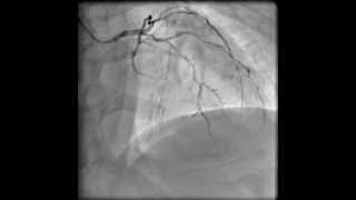 Left coronary angiogram RAO cranial [upl. by Avram]