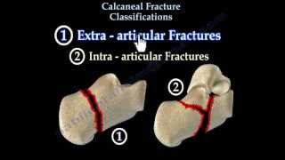 Calcaneal Fracture Classifications  Everything You Need To Know  Dr Nabil Ebraheim [upl. by Chiles]