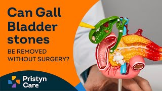 Can Gall Bladder stones be removed without surgery For FREE Appointment Call On 6366526478 [upl. by Haseefan]