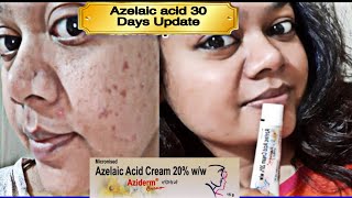 Azelaic acid 30 Days Update  Aziderm 20 ww Cream Review  Pimples को कैसे रोके [upl. by Ater797]