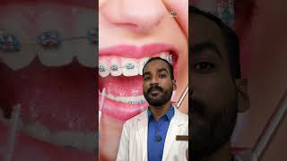 🤷‍♂️Teeth Gap Treatment dentist dentalclinic teethgapmakeover [upl. by Dnalyag214]