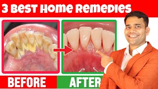 3 Remedies To Remove yellowness Plaque Cavities and Gingivitis  Dr Vivek Joshi [upl. by Dygall278]