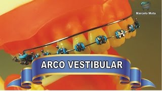 ARCO VESTIBULAR ACESSÓRIO para expansão dentoalveolar [upl. by Alaet]