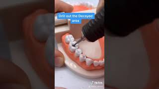 How to Fill a Cavity [upl. by Phonsa]