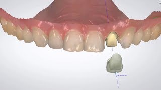 3Shape Dental System  Digital Temporaries Design [upl. by Feliza295]