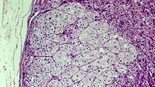 Prostate Artery Embolization  A NonInvasive Treatment for BPH  ARA Diagnostic Imaging [upl. by Haneen]