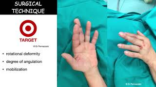 Percutaneous intramedullary screw fixation of metacarpal and phalangeal fractures [upl. by Felipa]