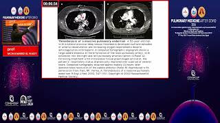 HIGH RISK PULMONARY EMBOLISM [upl. by Sanoy]