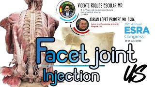 FACET JOINT INJECTION ESRA 2022 VIDEO CONTESTTHESSALONIKI [upl. by Ahsiakal]