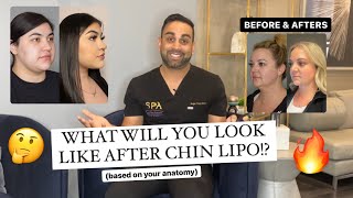 How Youll Look After Chin Lipo Before and After [upl. by Haidabej449]