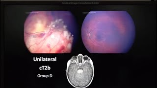 Retinoblastoma Pathology  Dr Brenda Gallie [upl. by Irehj]