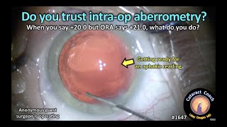 CataractCoach 1647 do you trust intraop aberrometry [upl. by Gyatt310]