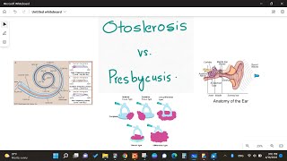 Otosclerosis vs Presbycusis [upl. by Yrallam]