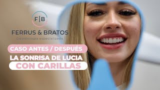 💋 CARILLAS DENTALES de PORCELANA ✨ Sonrisa perfecta [upl. by Lasko]