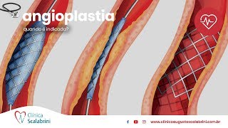 Quando é Indicada a Angioplastia [upl. by Yelnats]