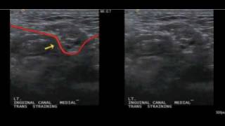 Normal inguinal wall motion [upl. by Tengler]