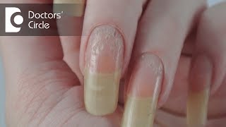 What can cause deep holes in nails amp is it related to stress  Dr Nischal K [upl. by Daffy232]