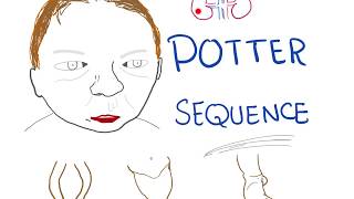 Potter sequence  Oligohydramnios Lowset Ears Flat Face ParrotPeak Nose Lung Hypoplasia [upl. by Llen]