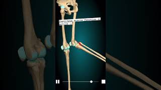 Popliteus Release for Knee Pain 😮‍💨shorts kneepain [upl. by Otrebmal592]