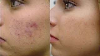 Mascarilla para el Acne y Anti Edad Natural para Todo Tipo de Piel [upl. by Venetia]