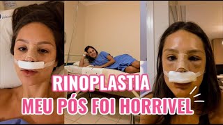 Minha Rinoplastia  como foi o pós COM FOTOS [upl. by Trubow863]