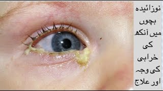 Eye infection reason and treatment in newborn babies UrduHindi [upl. by Nomyar]