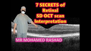 Super secrets to easily interpret Retinal Spectral Domain Optical Coherence Tomography [upl. by Aysab]