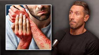 The True Cause of Eczema amp How to Heal [upl. by Robinson]