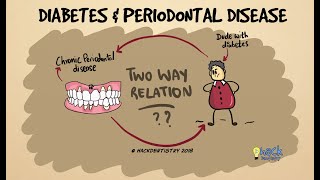 Diabetes and periodontitis The two way relationship [upl. by Ahsiket]