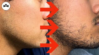 Minoxidil Beard Journey 3 Years [upl. by Maddock376]