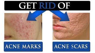 8 TIPS to get rid of ACNE SCARS amp MARKS on your face [upl. by Cirenoj794]