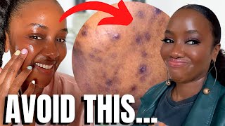 5 Things to Do for CLEAR Skin NOW  Black amp Brown Skin [upl. by Rahs153]