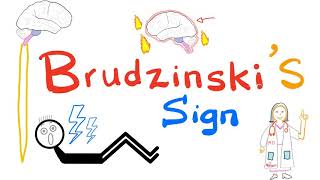 Brudzinskis Sign  Meningitis  Neurology  Physical Exam [upl. by Avivah]