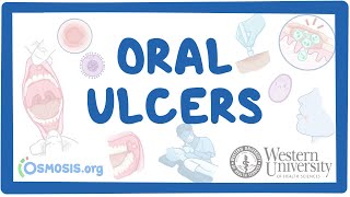 Western University  Oral Ulcers [upl. by Rento880]