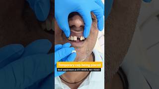 Temporary Cap over Front Dental Implant Try Maryland Bridge Dr Srishti Bhatia teeth dental [upl. by Fogarty]