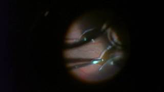 Retinal Detachment Repair  25 gauge Vitrectomy with Gas [upl. by Bohlin]