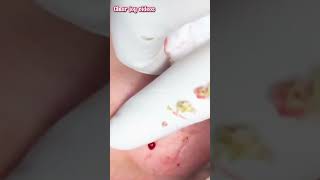 Big Cystic Acne Blackheads ExtractionBlackheads amp Milia Whiteheads Removal Pimple Popping [upl. by Assilanna]