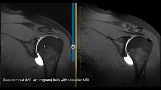 Does MRI arthrogram help see the labrum [upl. by Yarled]