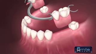 Removable denture Beirut Lebanon  Dentist Lebanon [upl. by Katee]