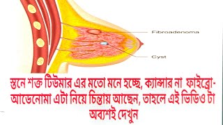 Discussion of Breast fibroadenomaits causesdiagnosisHomeopathic treatmenthow to prevent it [upl. by Jamison]