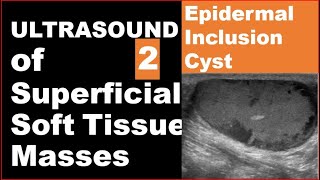 Epidermoid inclusion cyst on Ultrasound [upl. by Aidne253]