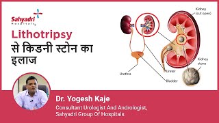 Lithotripsy से किडनी स्टोन का इलाज  Lithotripsy for Kidney Stones  Dr Yogesh Kaje Sahyadri [upl. by Gladine919]