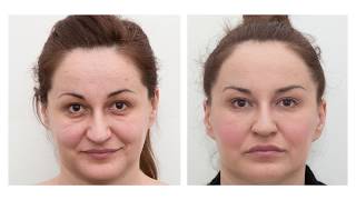 The results of dermal fillers before and after [upl. by Gridley]