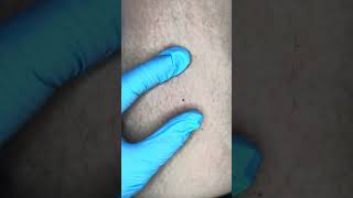 Watch Electrolysis Now Zap Hairs with Me [upl. by Rawlinson]