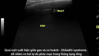 Case 132  Chilaiditi syndrome  Riedel lobe [upl. by Cuthbert]