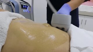 Reduce la flácidez en cuerpo y rostro  Exilis Elite [upl. by Prudie255]