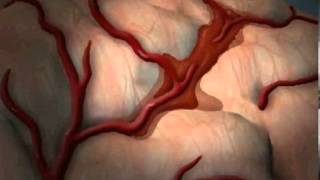 What is Stroke Cerebrovascular Accident [upl. by Llerrut808]