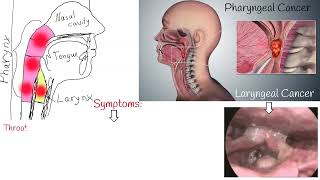 Throat cancer  Symptoms causes and Treatment Laryngeal Cancer and Pharyngeal Cancer [upl. by Choong]